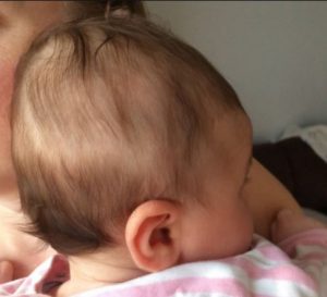 علل ریزش موی نوزاد