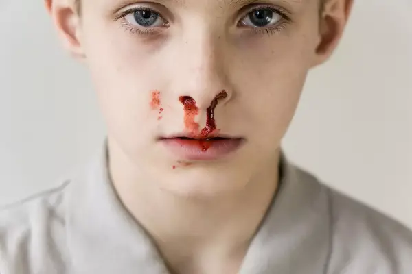 علت خون دماغ شدن کودکان از یک سوراخ بینی