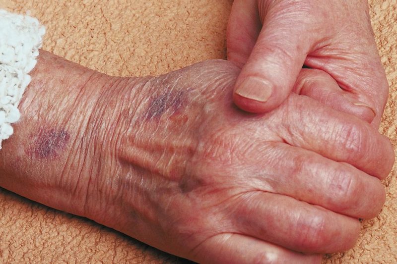 مراقبت از سالمندان بیمار و عوامل ابتلا به زونا را بشناسید