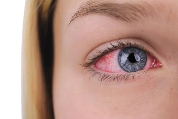 درمان قرمز شدن چشم