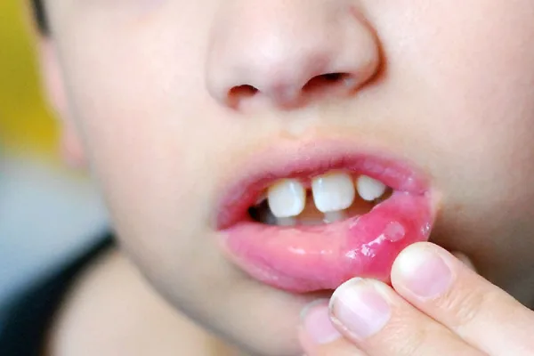 مراحل درمان آفت دهان در کودکان چیست