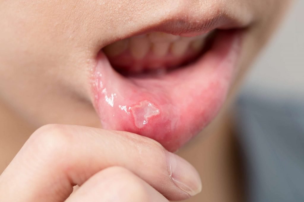  تشخیص و درمان آفت دهان در کودکان