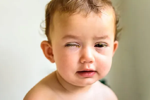 درمان.عفونت.چشم.نوزاد
