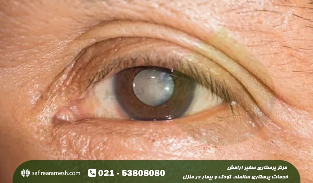 آب مروارید در سالمندان