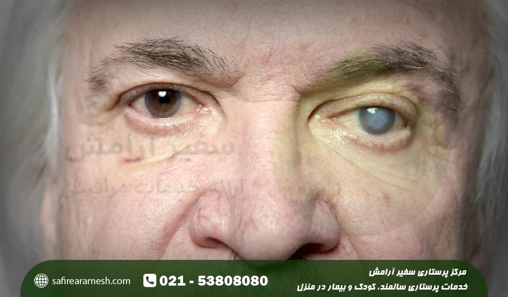 انواع اب مروارید چشم در سالمندان