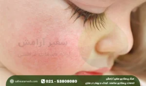 اگزما در نوزادان + عکس