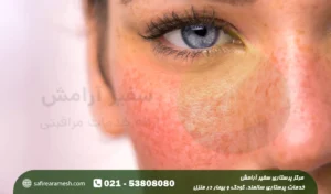 بیماری پنجم