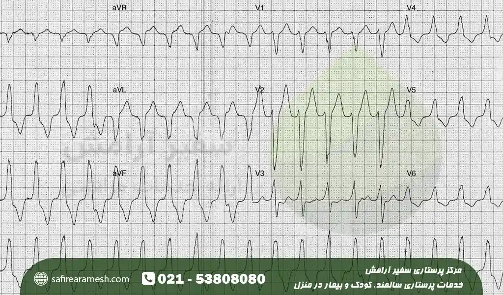 تاکیکاردی در کودکان چیست