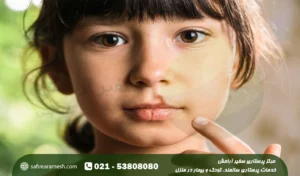 تبخال دهان کودکان