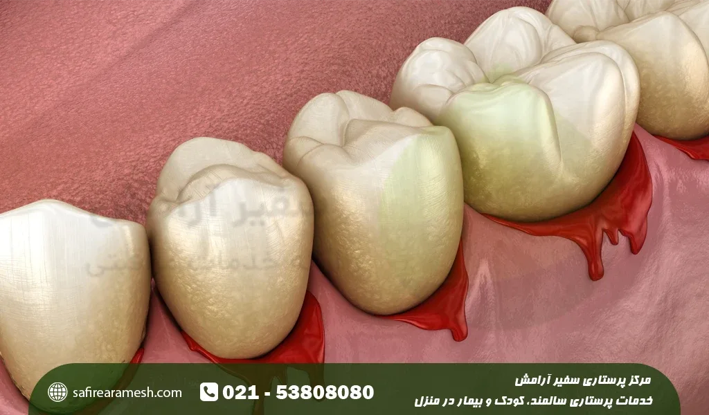 درمان خونریزی لثه در منزل