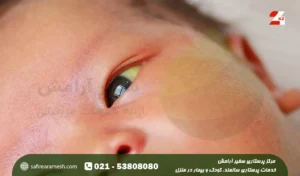 درمان خانگی زردی نوزاد سه روزه