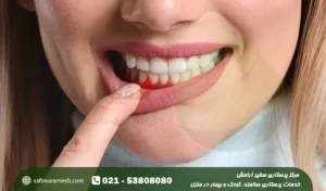 جلوگیری از خونریزی لثه