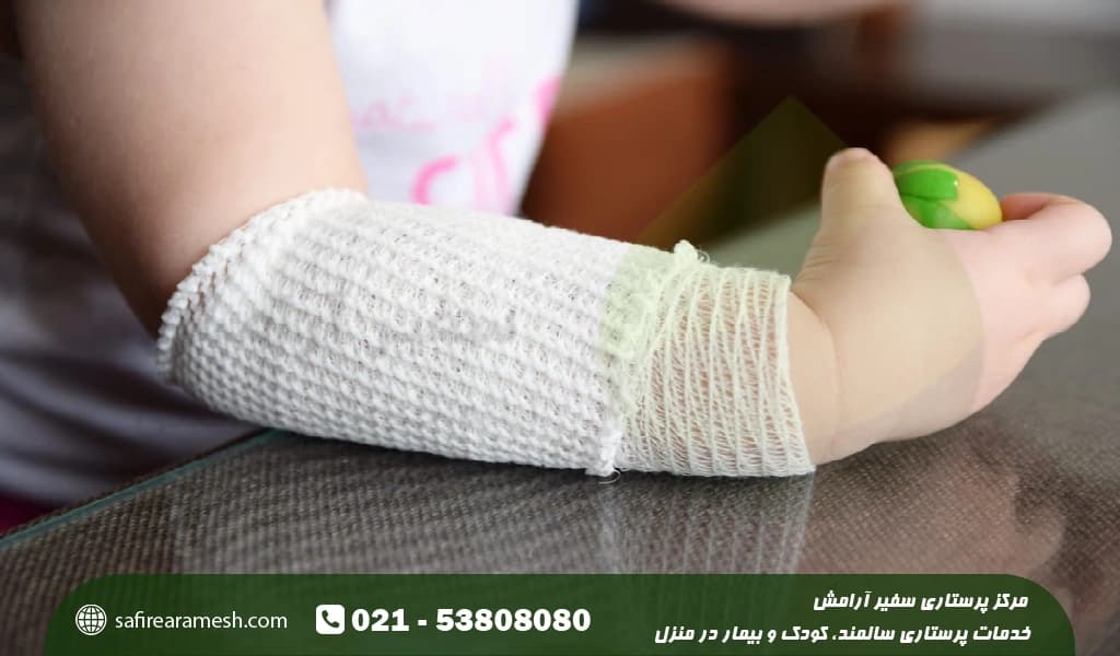 درمان سوختگی دست کودک با بخاری