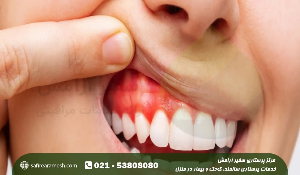 علائم عقب رفتن لثه