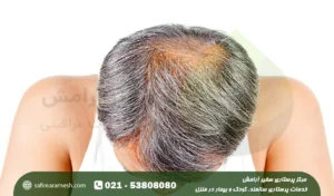 علت ریزش مو در سالمندان