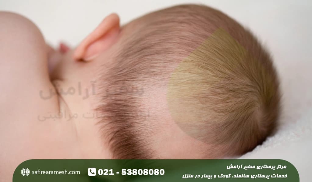 کچلی سر در کودکان