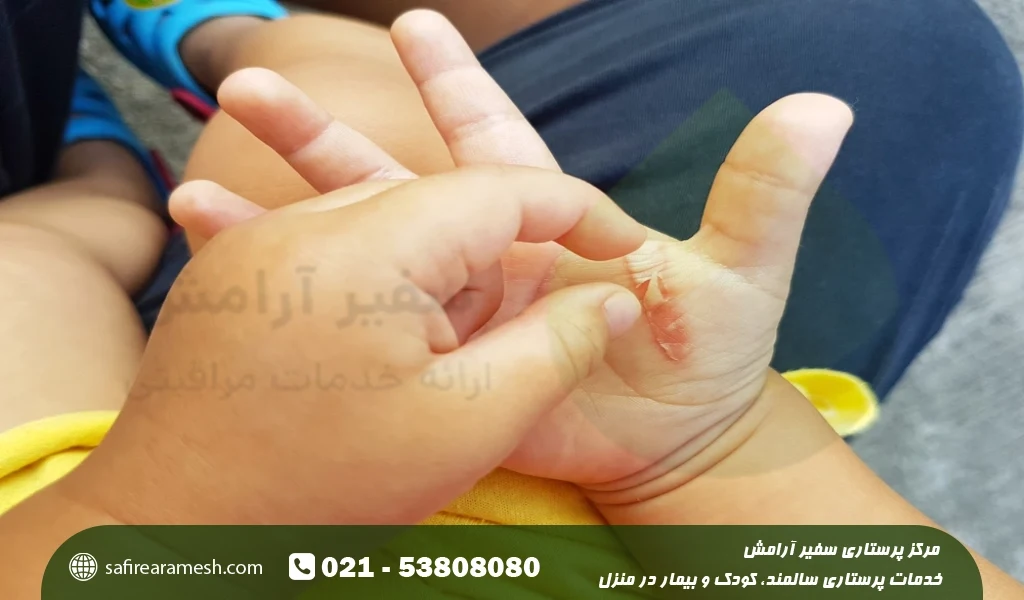 درمان سوختگی با چای داغ در کودکان