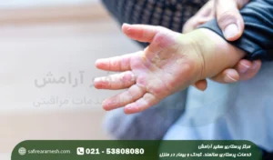 سوختگی در کودکان؛ اقدامات اولیه در سوختگی بچه ها