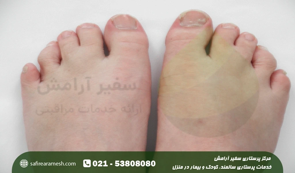 نحوه پیشگیری از چسبندگی انگشت کودکان