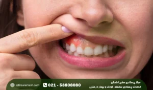 عقب نشینی لثه؛ علت عقب رفتن لثه و درمان آن