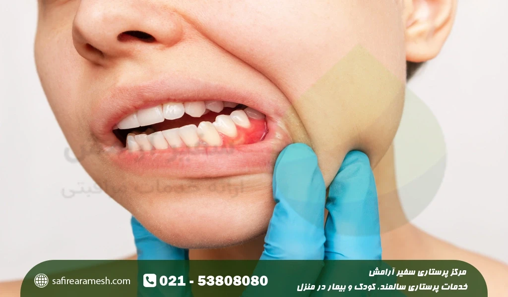 عقب نشینی لثه چیست؟