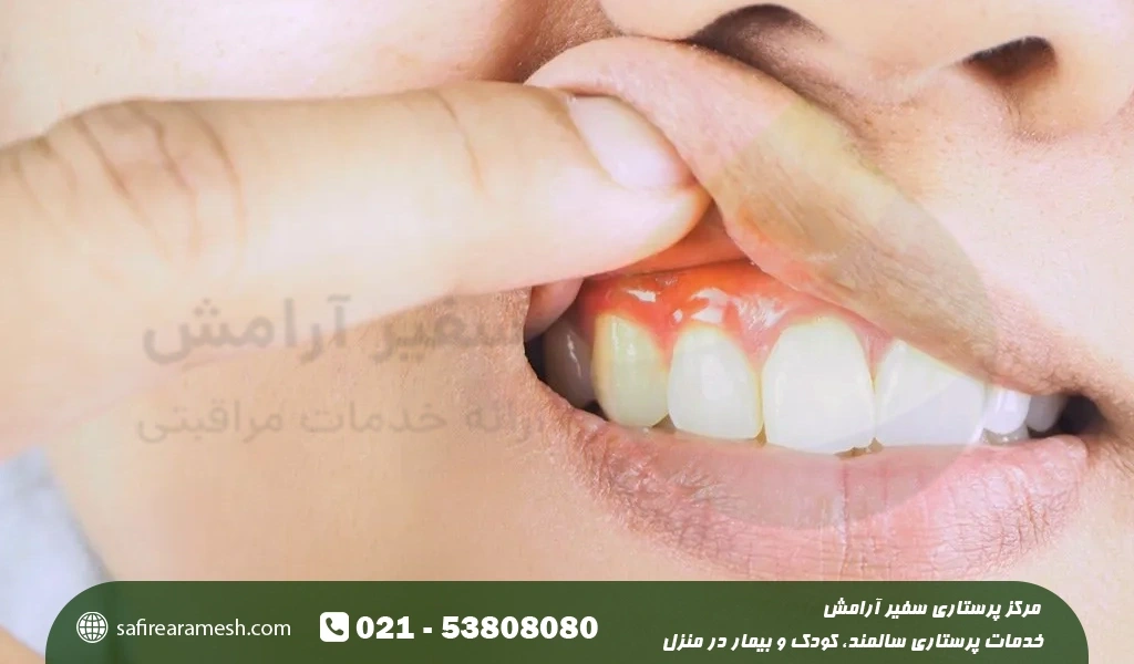 راه های جلوگیری از عقب رفتن لثه