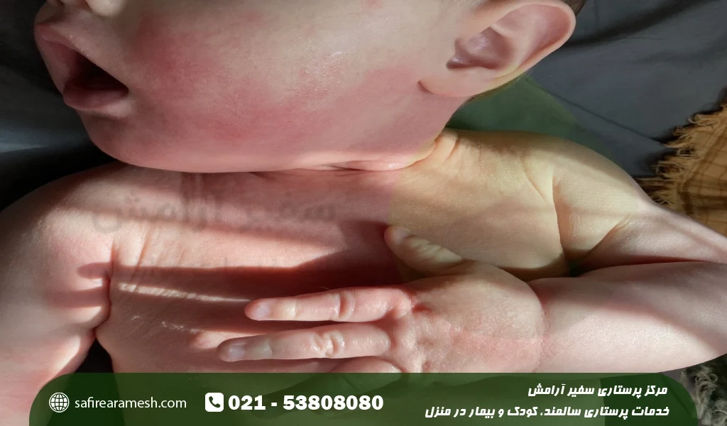 درمان حساسیت به بادام درختی و بادام زمینی