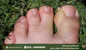 درمان چسبندگی انگشتان در کودکان؛ علت سندروم سینداکتیلی