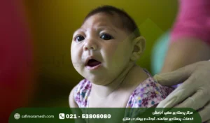 بیماری میکروسفالی؛ علائم میکروسفالی شدید با عکس