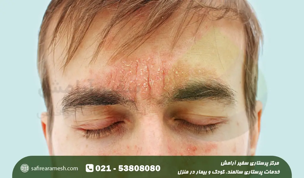 بیماری پسوریازیس صورت