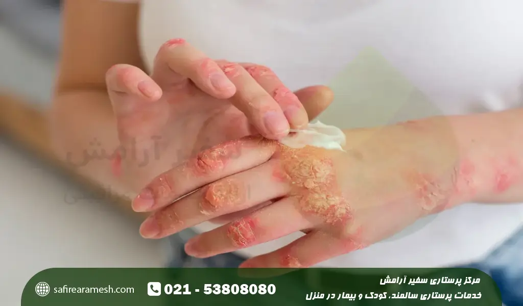 بیماری پسوریازیس دست