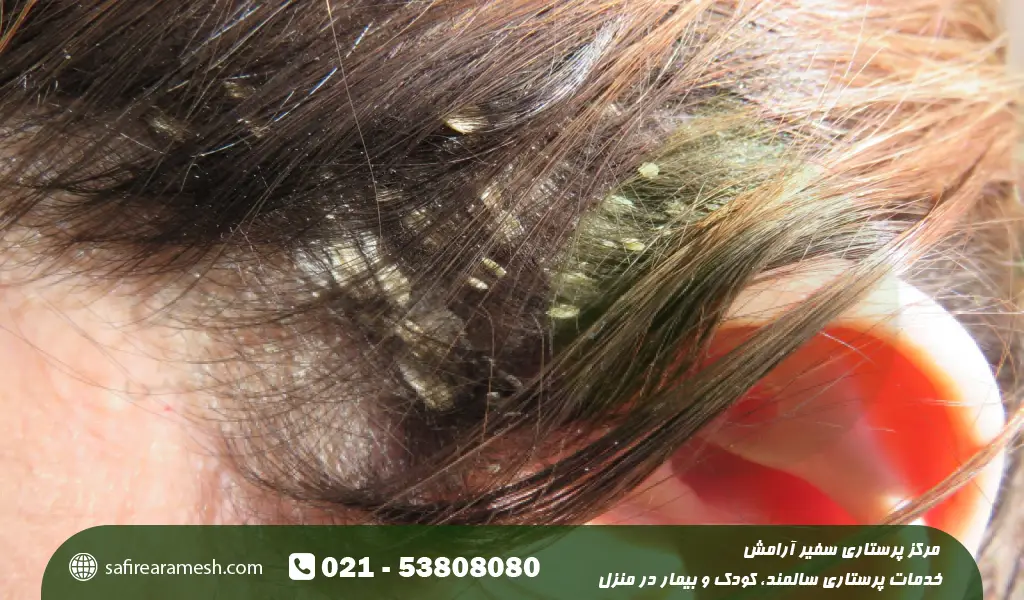 بیماری پسوریازیس سر