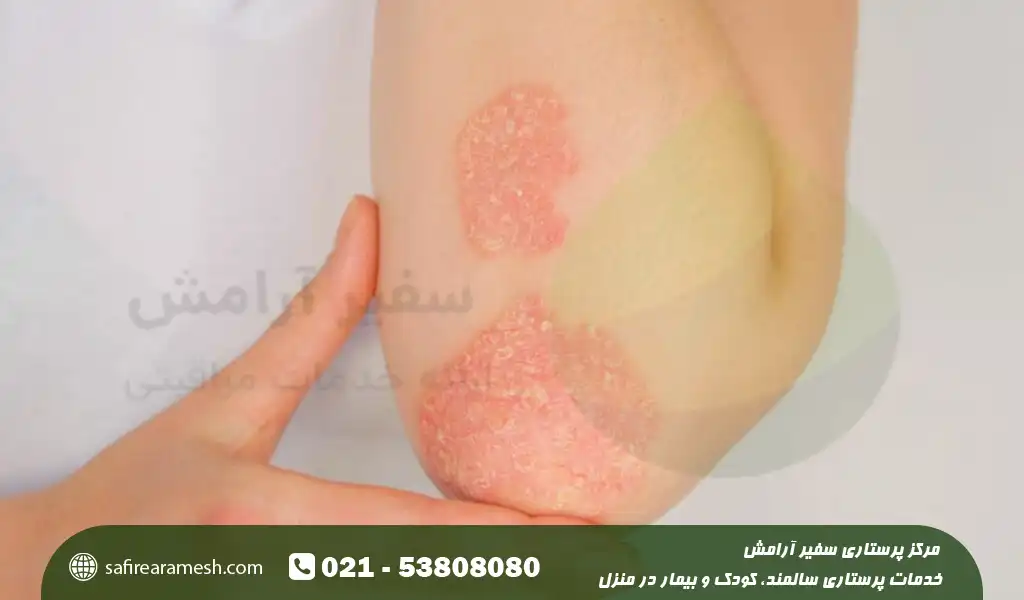 بیماری صدف پوستی