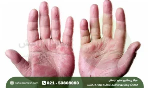 پسوریازیس چیست؟