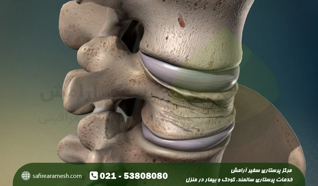 برای پوکی استخوان چه چیزی مفید است؟