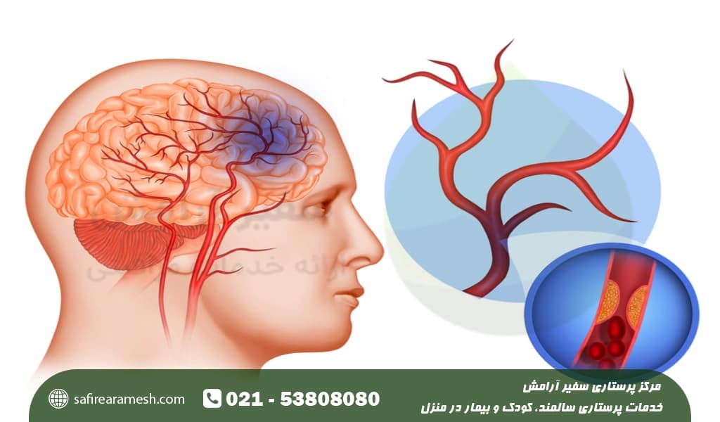 دلایل و علت خونریزی مغزی