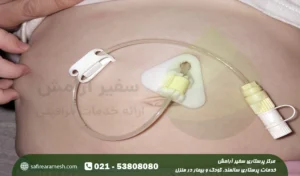 پگ معده؛ نکات مهم مراقبت از peg معده