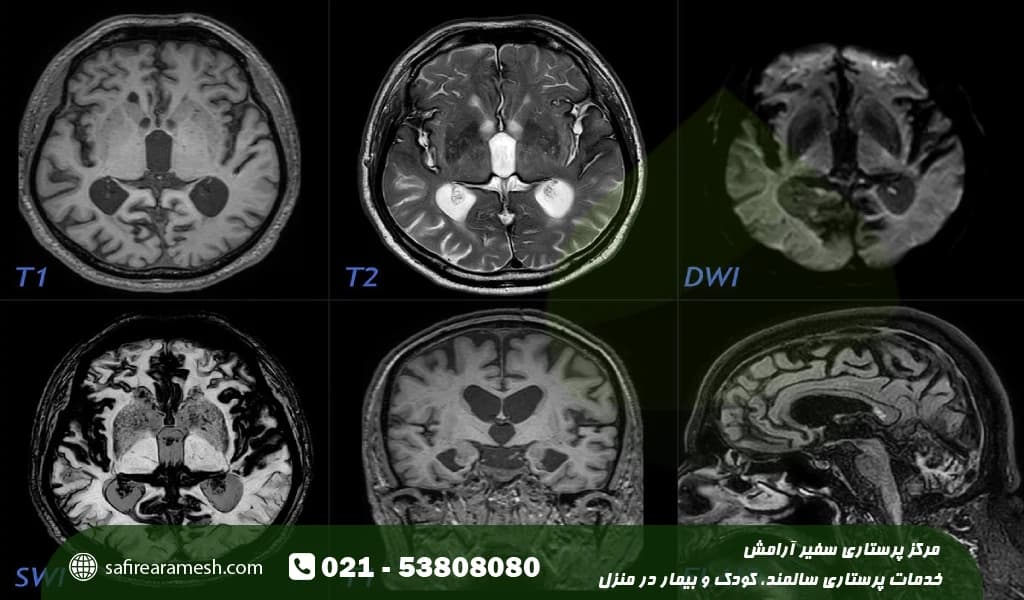 خونریزی مغزی چیست + عکس خونریزی مغزی