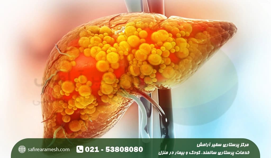 بیماری کبد چرب و انواع کبد چرب