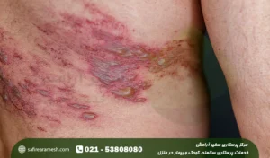 زونا در سالمندان