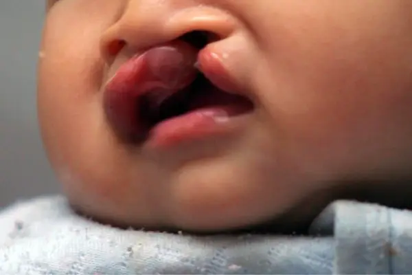 درمان و تشخیص شکاف کام لب در نوزادان