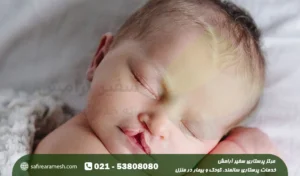 شکاف لب نوزادان