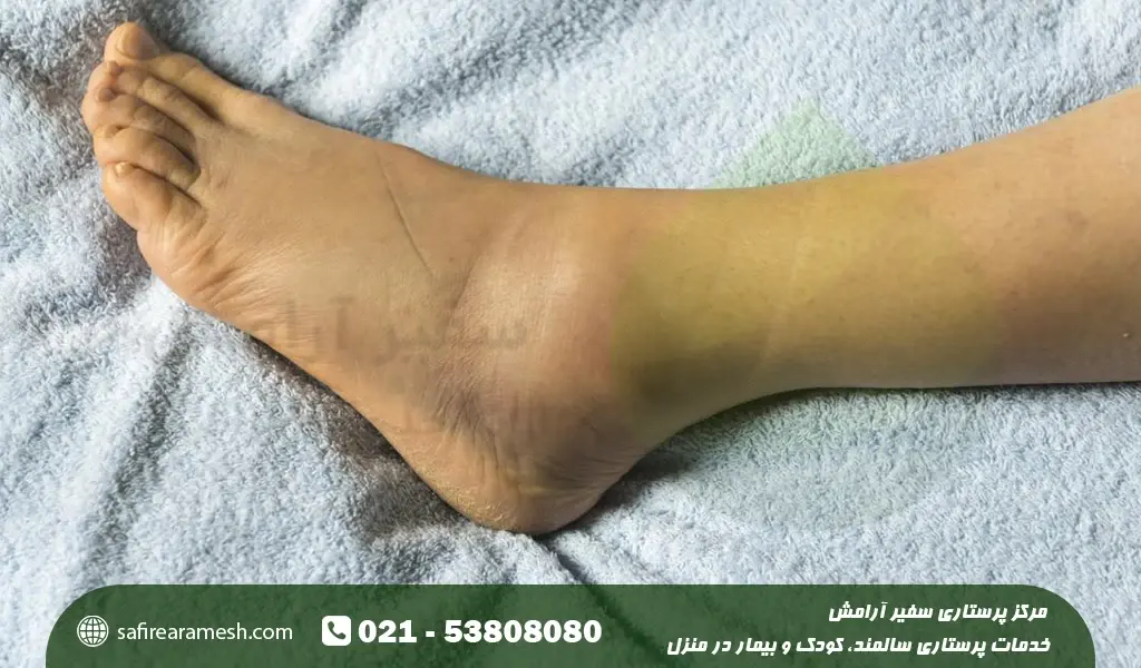 ورم پا در سالمند