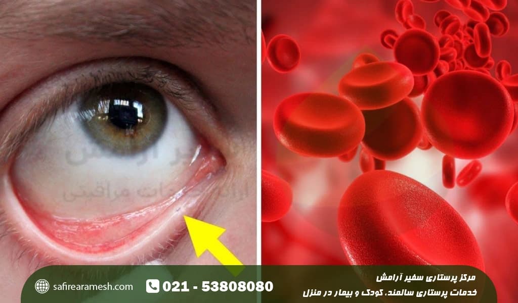 علت کم خونی در زنان سالمند