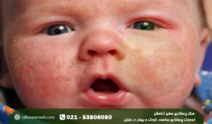 درماتیت آتوپیک در کودکان