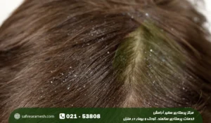 شوره سر در کودکان