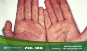 قارچ پوستی چیست؟ درمان قارچ پوستی در کودکان و بزرگسالان