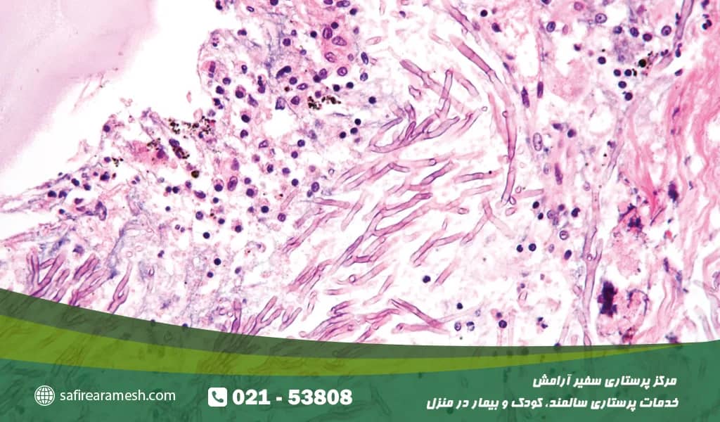 انواع عفونتهای قارچی پوستی