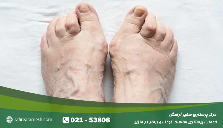 پا درد سالمندان