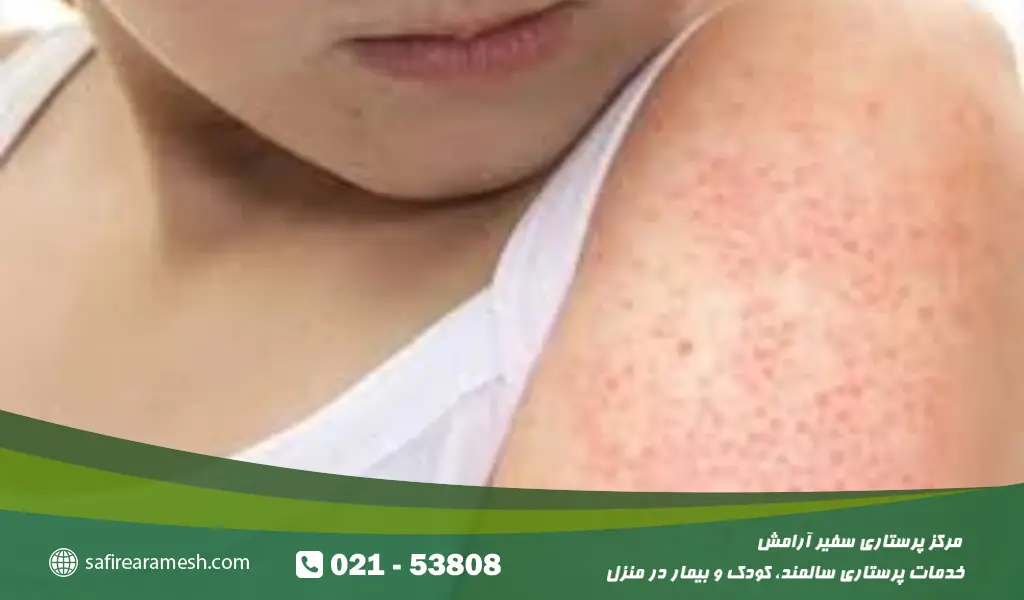 حساسیت پوستی در کودکان و نوزادان